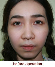 plastic_surgery_augmentation_rhinoplasty